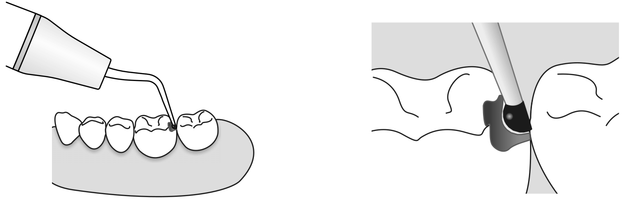 Сфера применения наконечника для скалера